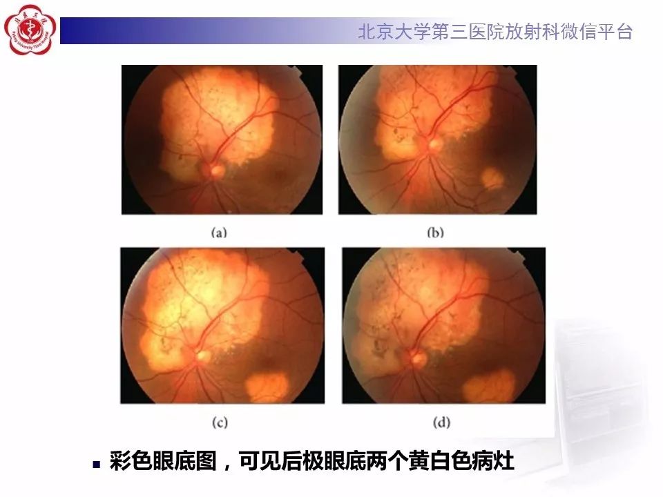 影像PPT - 【PPT】脉络膜骨瘤的影像表现-24