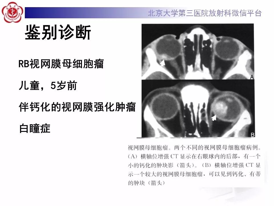 影像PPT - 【PPT】脉络膜骨瘤的影像表现-26