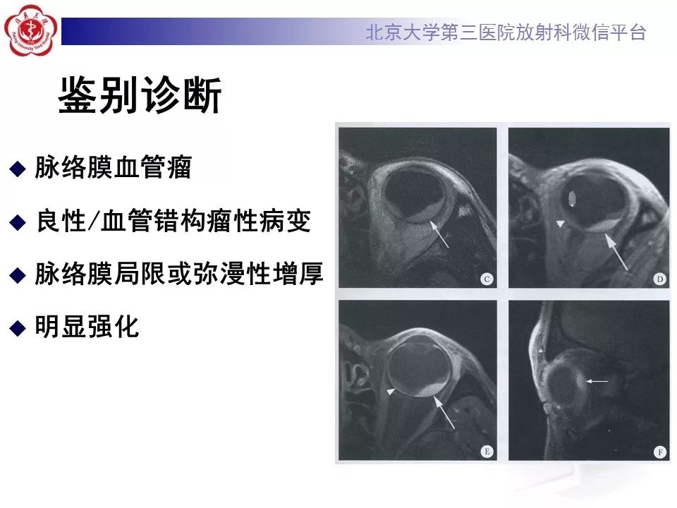 影像PPT - 【PPT】脉络膜骨瘤的影像表现-27