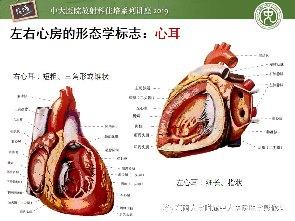 影像PPT - 【PPT】复杂先心病分段分析法简介-6