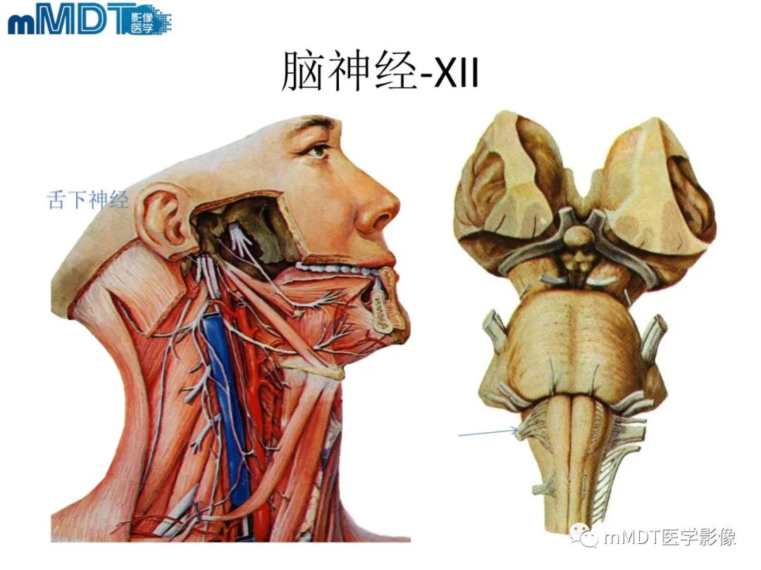 影像PPT - 【PPT】脑神经的影像辨识-15 影像PPT - 【PPT】脑神经的影像辨识-15