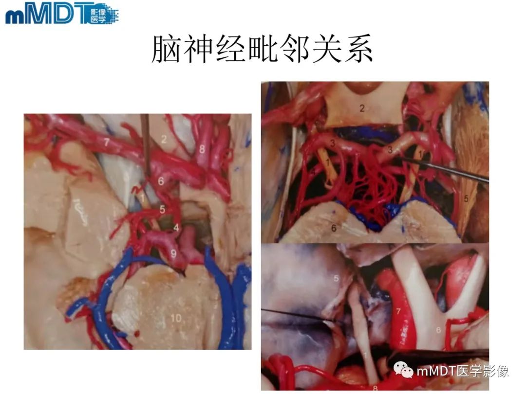 影像PPT - 【PPT】脑神经的影像辨识-16 影像PPT - 【PPT】脑神经的影像辨识-16