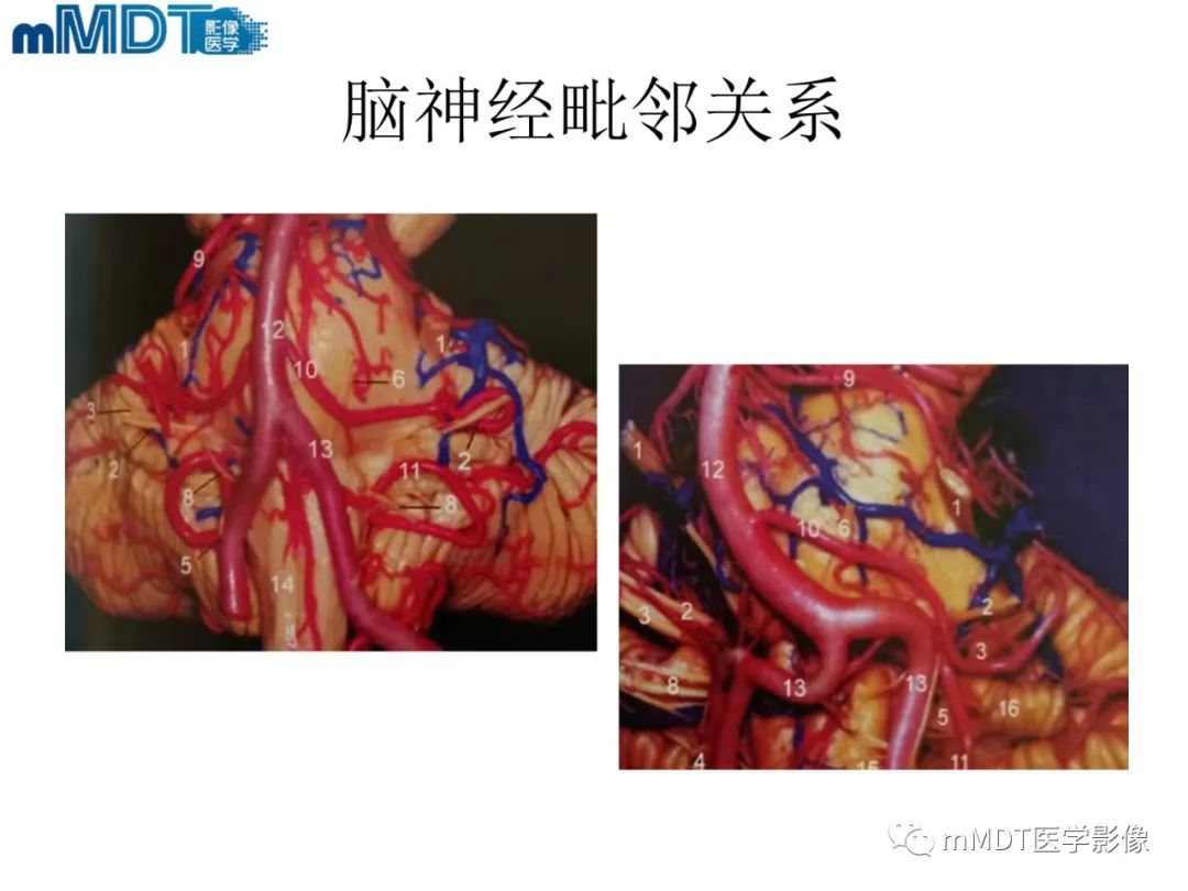 影像PPT - 【PPT】脑神经的影像辨识-17 影像PPT - 【PPT】脑神经的影像辨识-17