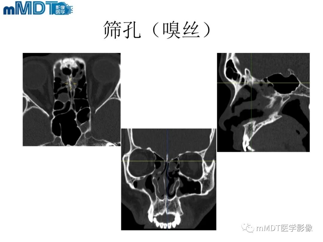 影像PPT - 【PPT】脑神经的影像辨识-19 影像PPT - 【PPT】脑神经的影像辨识-19