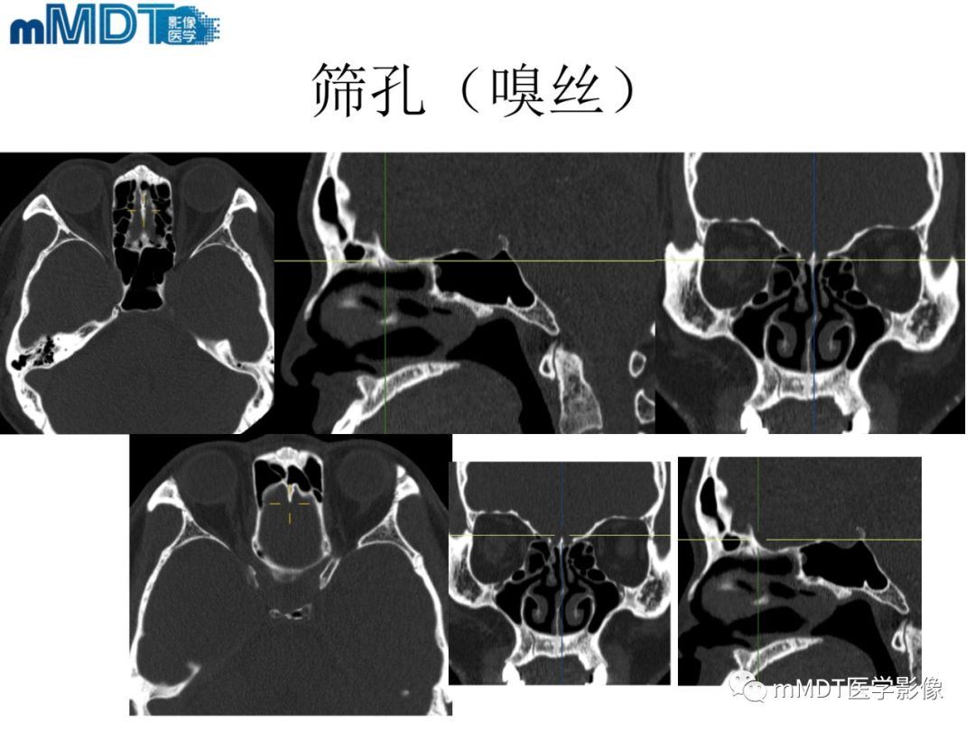 影像PPT - 【PPT】脑神经的影像辨识-20 影像PPT - 【PPT】脑神经的影像辨识-20