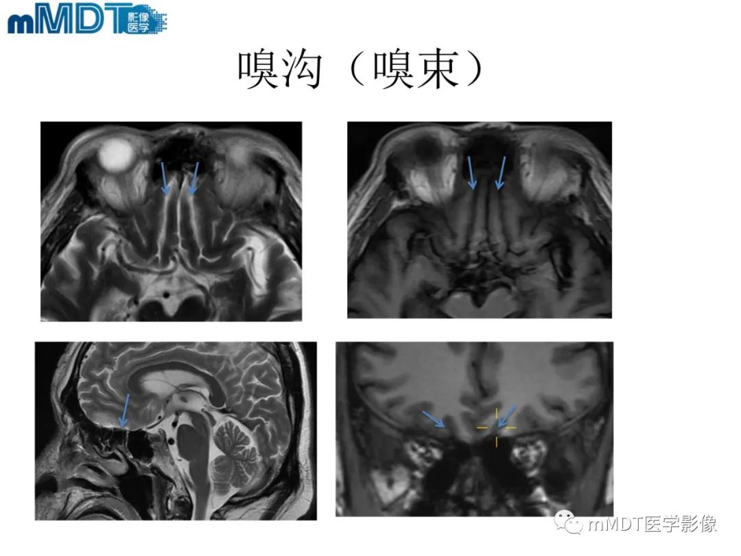 影像PPT - 【PPT】脑神经的影像辨识-23 影像PPT - 【PPT】脑神经的影像辨识-23