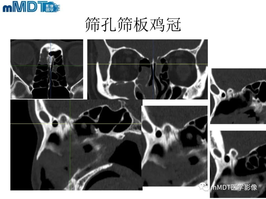 影像PPT - 【PPT】脑神经的影像辨识-21 影像PPT - 【PPT】脑神经的影像辨识-21