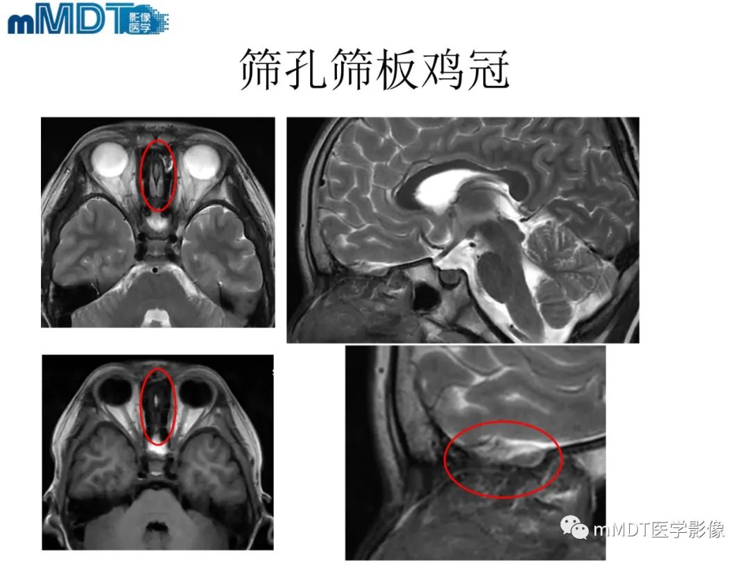 影像PPT - 【PPT】脑神经的影像辨识-22 影像PPT - 【PPT】脑神经的影像辨识-22