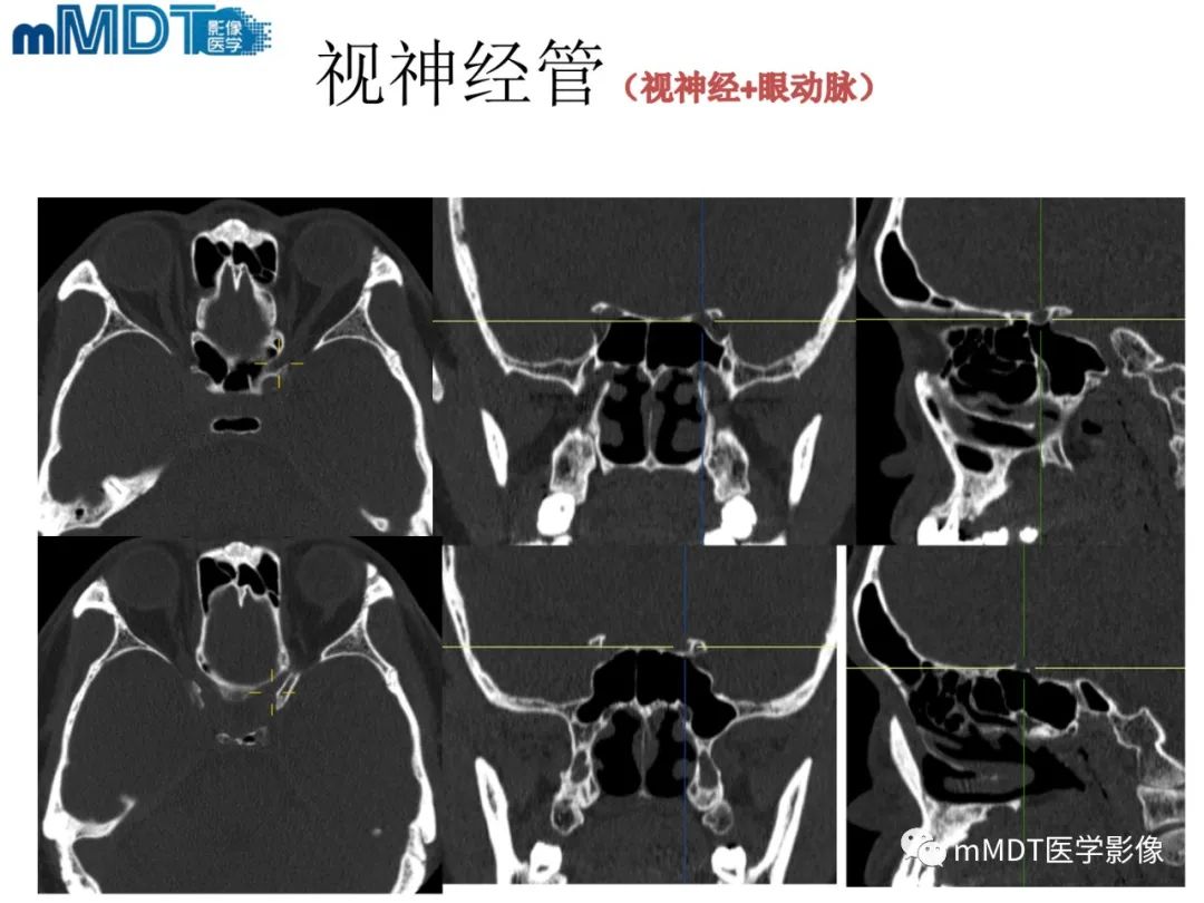 影像PPT - 【PPT】脑神经的影像辨识-24 影像PPT - 【PPT】脑神经的影像辨识-24