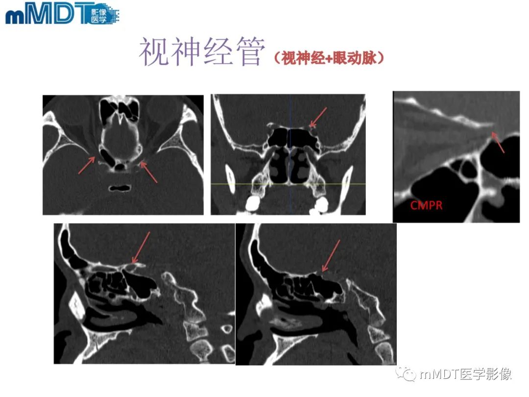 影像PPT - 【PPT】脑神经的影像辨识-25 影像PPT - 【PPT】脑神经的影像辨识-25