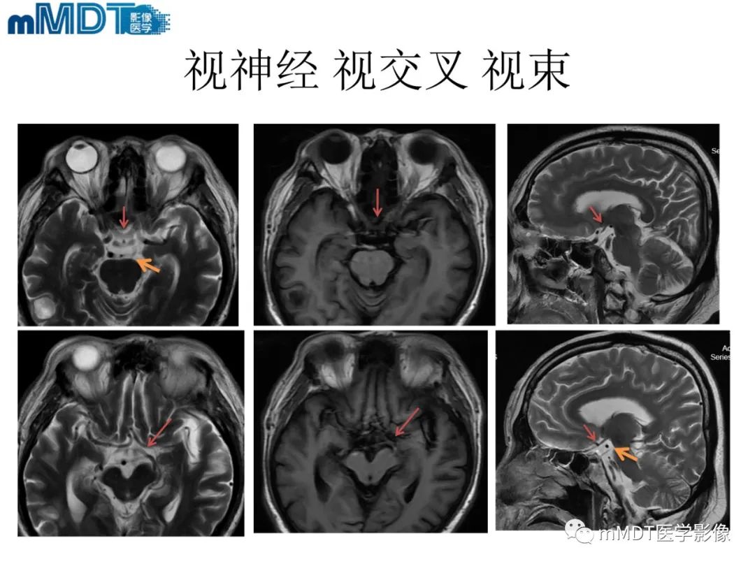 影像PPT - 【PPT】脑神经的影像辨识-26 影像PPT - 【PPT】脑神经的影像辨识-26