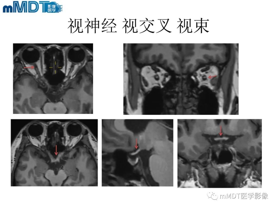 影像PPT - 【PPT】脑神经的影像辨识-27 影像PPT - 【PPT】脑神经的影像辨识-27