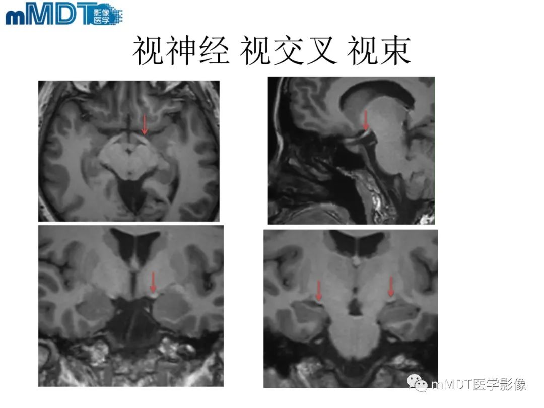 影像PPT - 【PPT】脑神经的影像辨识-28 影像PPT - 【PPT】脑神经的影像辨识-28