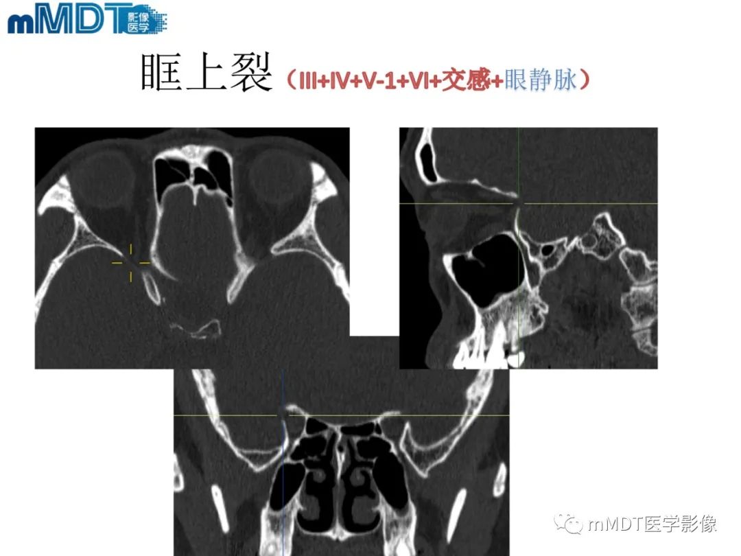 影像PPT - 【PPT】脑神经的影像辨识-29 影像PPT - 【PPT】脑神经的影像辨识-29