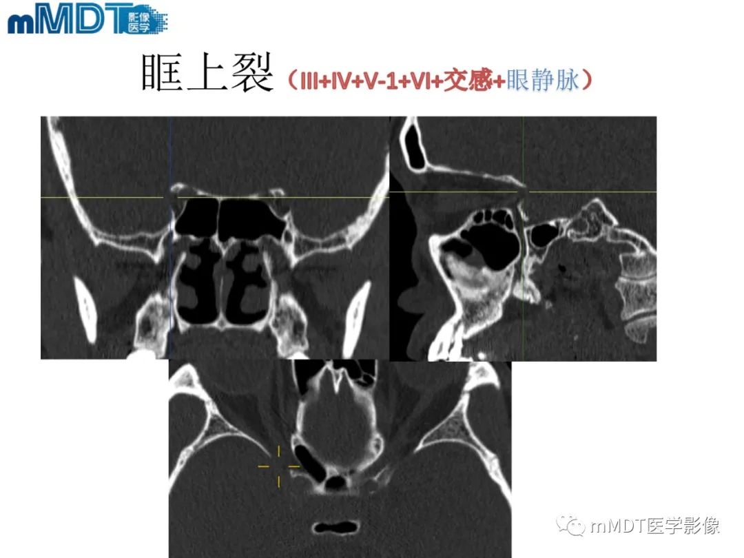 影像PPT - 【PPT】脑神经的影像辨识-30 影像PPT - 【PPT】脑神经的影像辨识-30