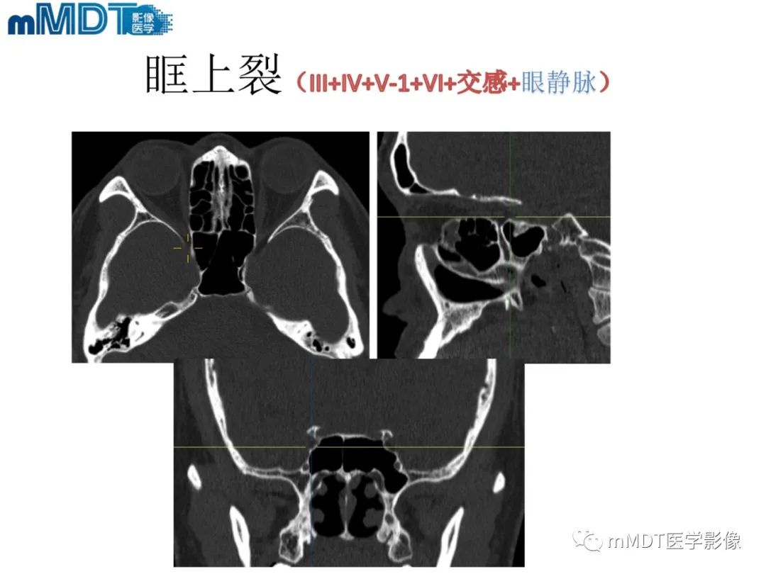 影像PPT - 【PPT】脑神经的影像辨识-31 影像PPT - 【PPT】脑神经的影像辨识-31