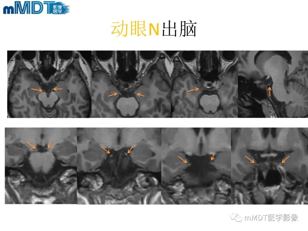 影像PPT - 【PPT】脑神经的影像辨识-33 影像PPT - 【PPT】脑神经的影像辨识-33