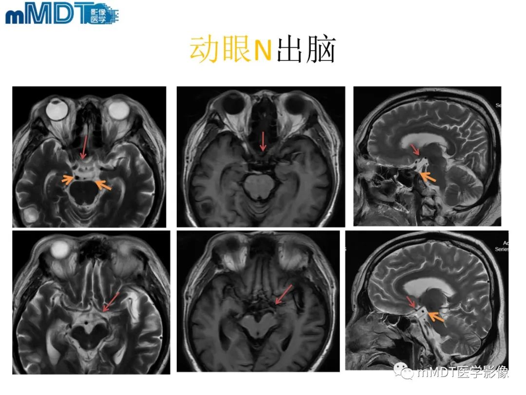 影像PPT - 【PPT】脑神经的影像辨识-32 影像PPT - 【PPT】脑神经的影像辨识-32