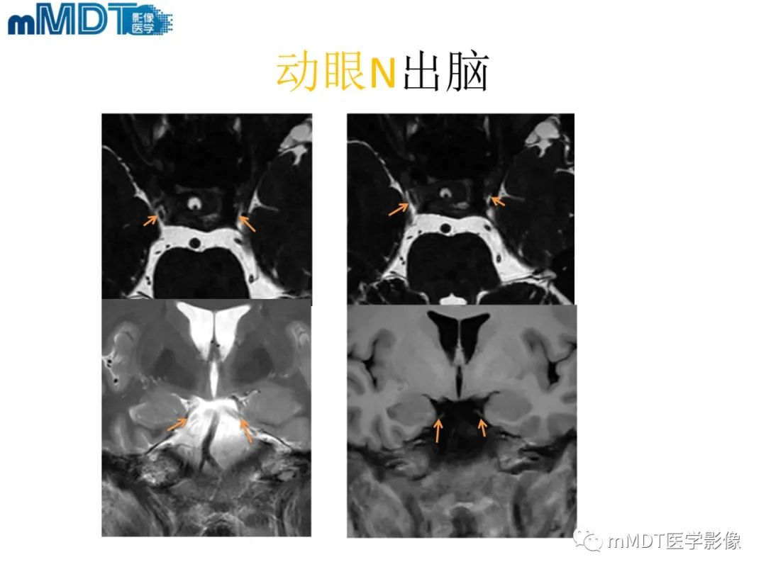 影像PPT - 【PPT】脑神经的影像辨识-35 影像PPT - 【PPT】脑神经的影像辨识-35
