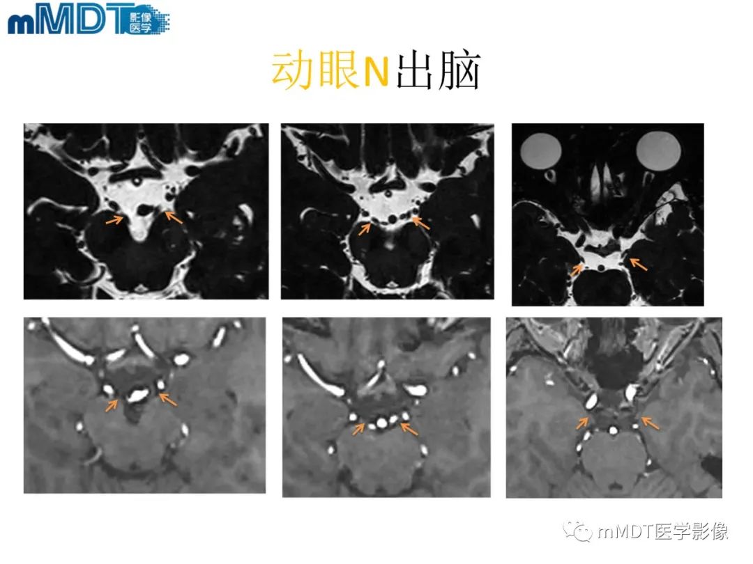 影像PPT - 【PPT】脑神经的影像辨识-34 影像PPT - 【PPT】脑神经的影像辨识-34