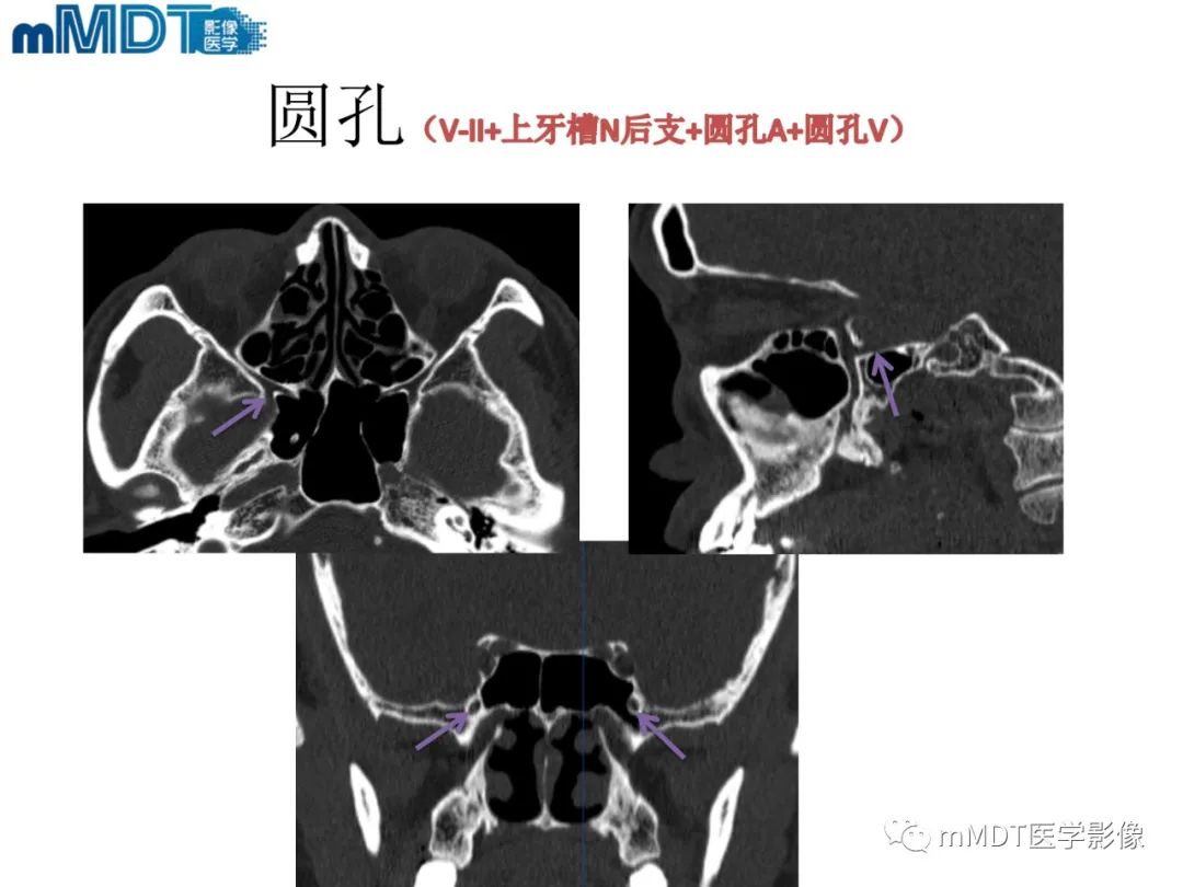 影像PPT - 【PPT】脑神经的影像辨识-36 影像PPT - 【PPT】脑神经的影像辨识-36