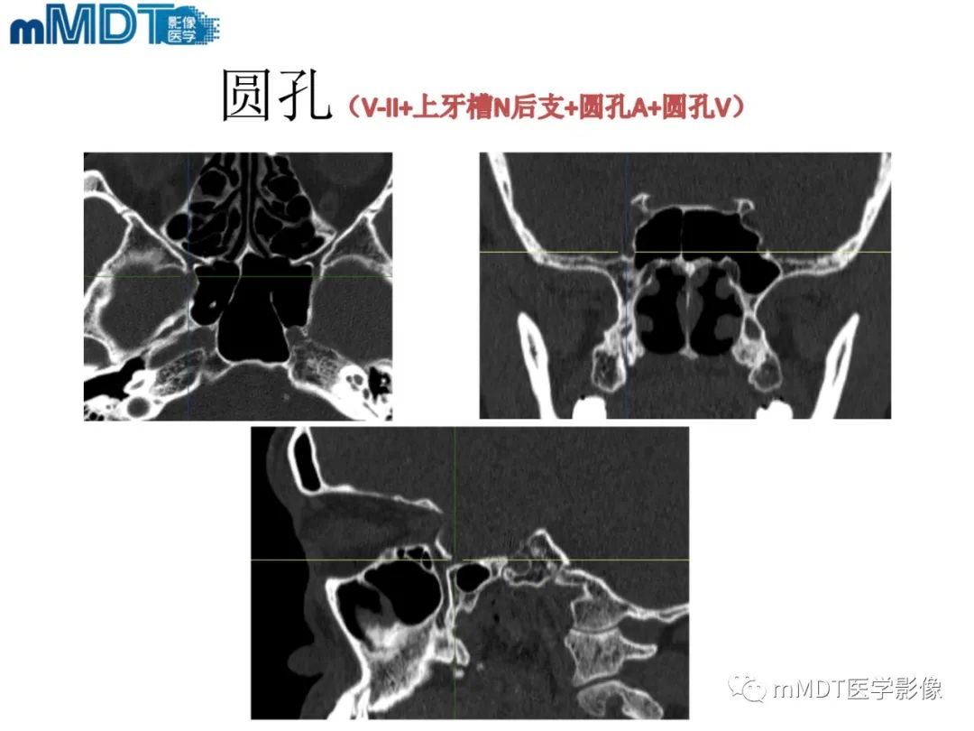 影像PPT - 【PPT】脑神经的影像辨识-37 影像PPT - 【PPT】脑神经的影像辨识-37