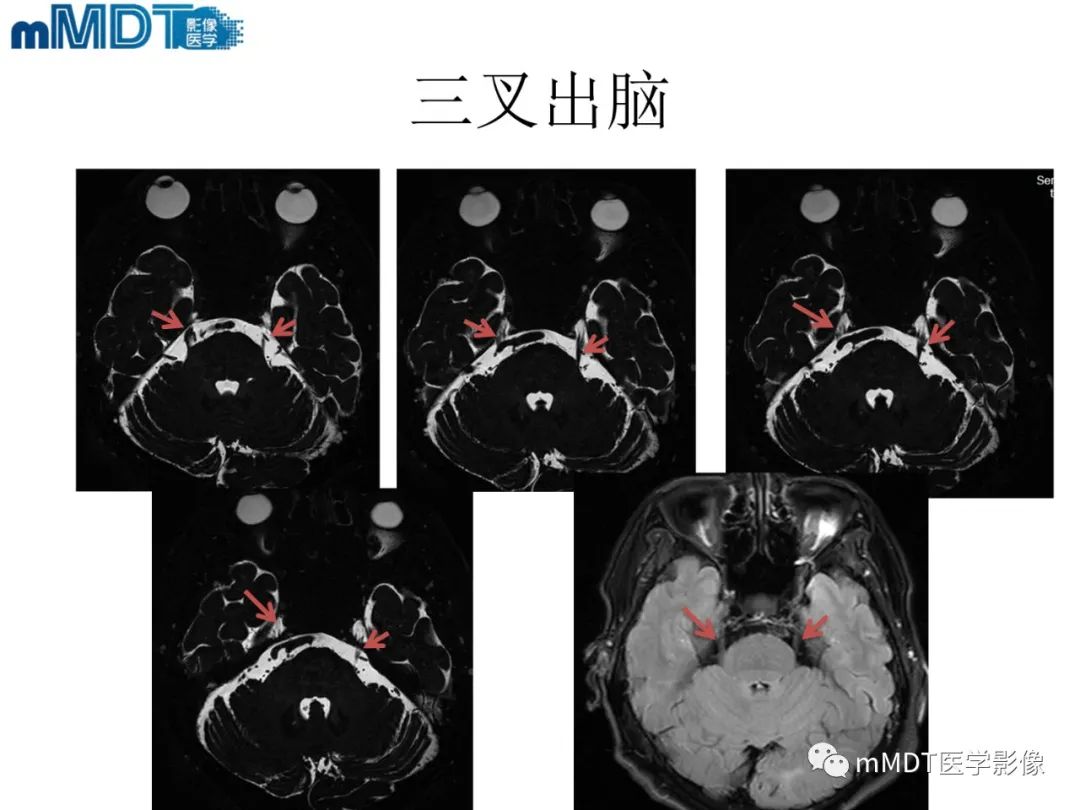 影像PPT - 【PPT】脑神经的影像辨识-40 影像PPT - 【PPT】脑神经的影像辨识-40