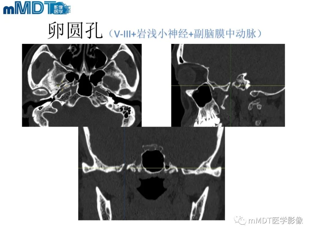 影像PPT - 【PPT】脑神经的影像辨识-38 影像PPT - 【PPT】脑神经的影像辨识-38