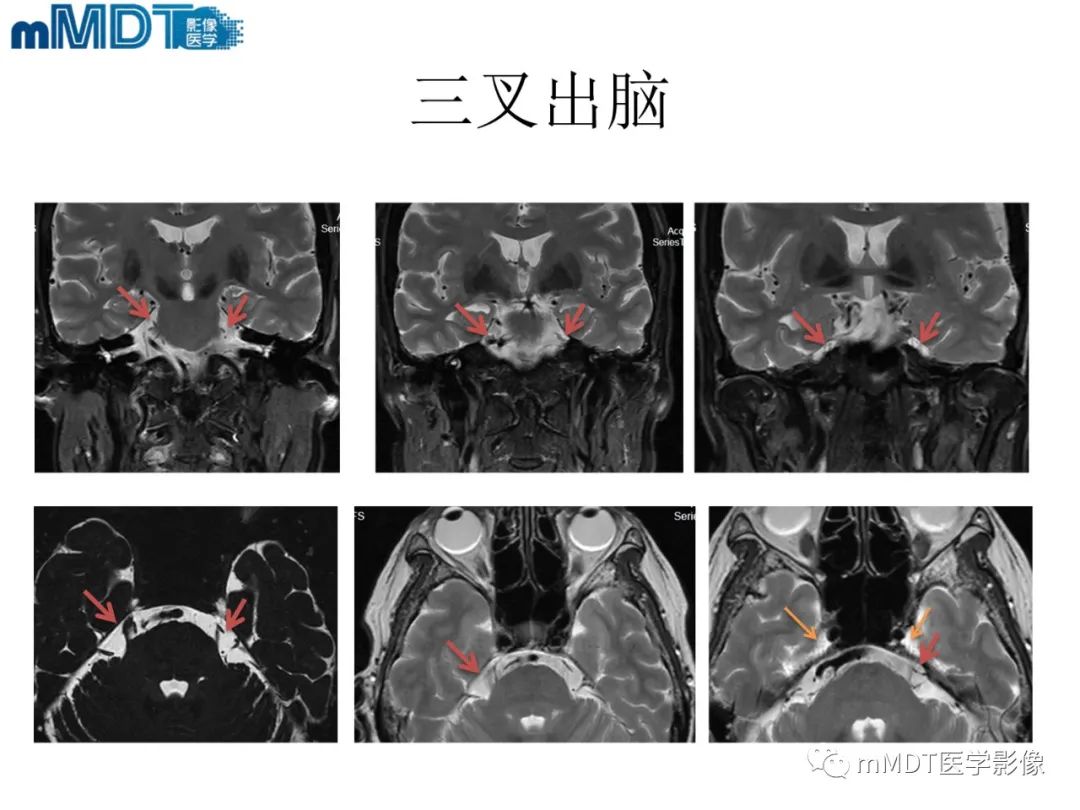影像PPT - 【PPT】脑神经的影像辨识-41 影像PPT - 【PPT】脑神经的影像辨识-41