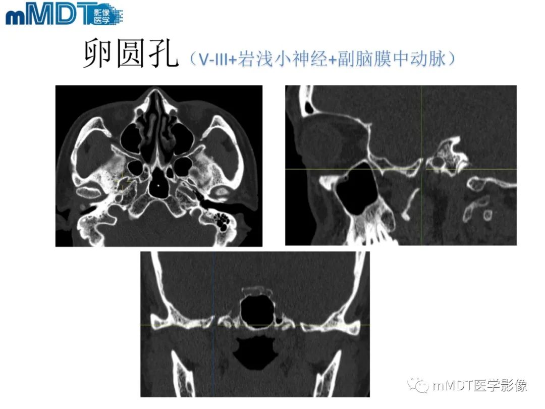 影像PPT - 【PPT】脑神经的影像辨识-39 影像PPT - 【PPT】脑神经的影像辨识-39