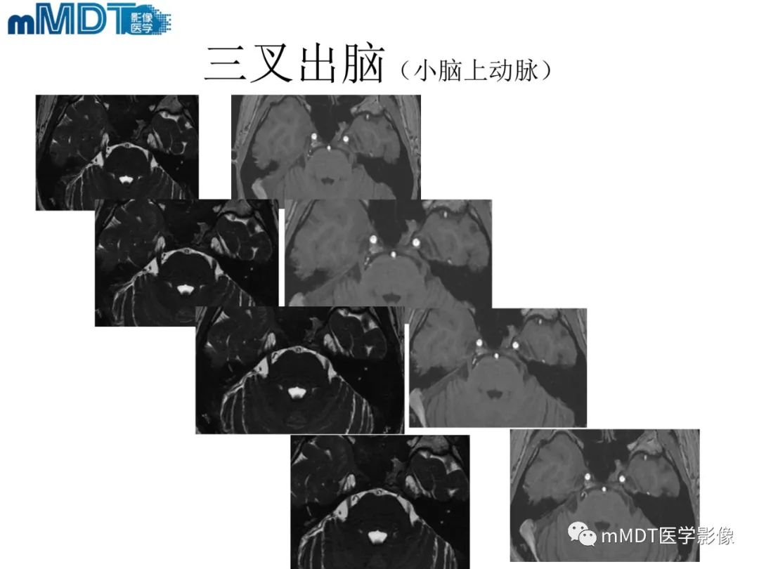 影像PPT - 【PPT】脑神经的影像辨识-43 影像PPT - 【PPT】脑神经的影像辨识-43