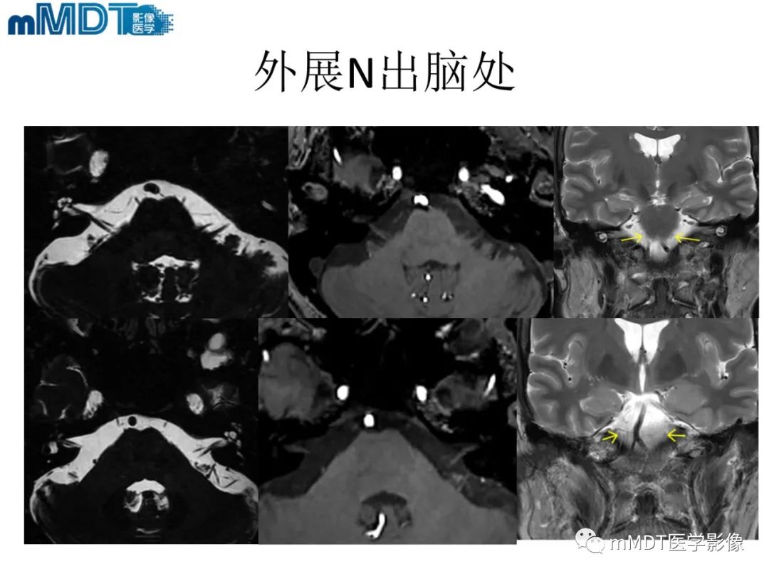 影像PPT - 【PPT】脑神经的影像辨识-45 影像PPT - 【PPT】脑神经的影像辨识-45