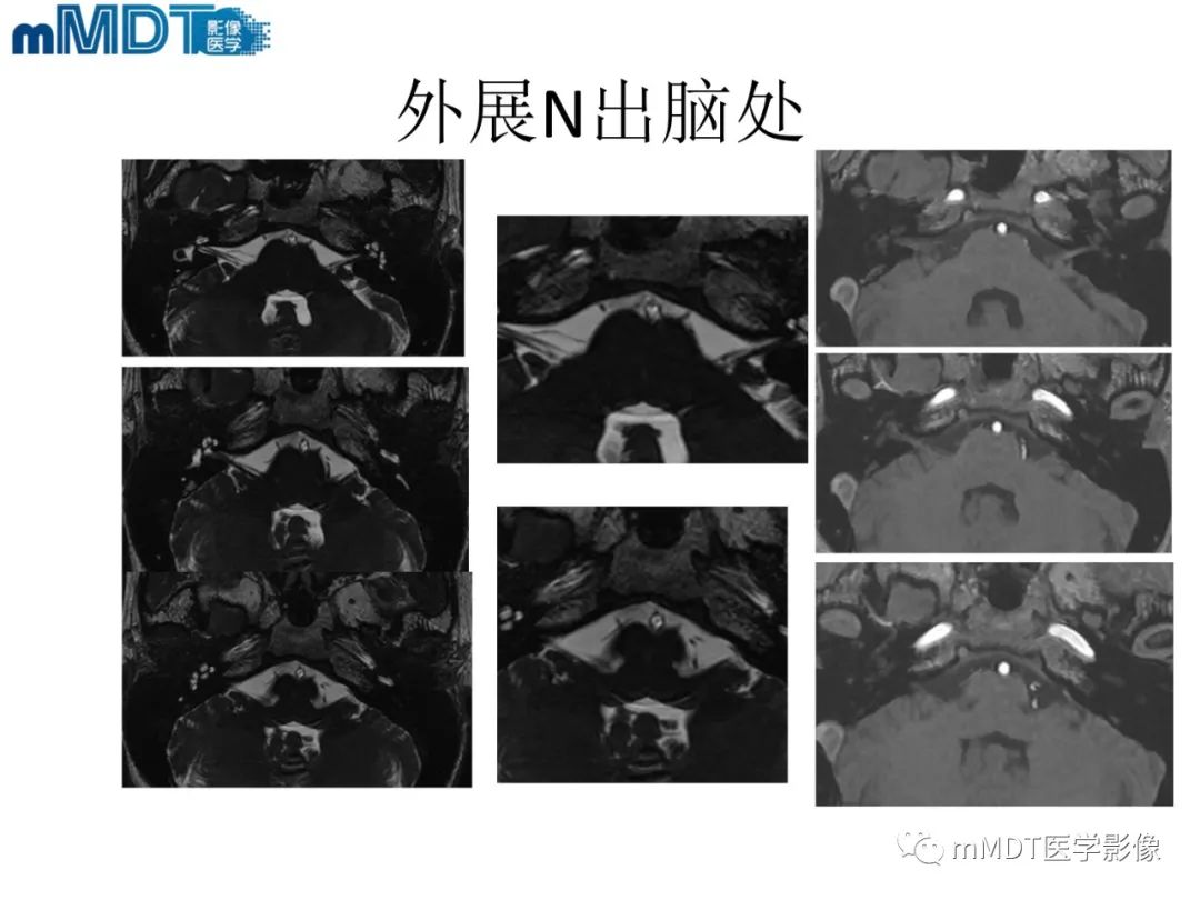 影像PPT - 【PPT】脑神经的影像辨识-44 影像PPT - 【PPT】脑神经的影像辨识-44