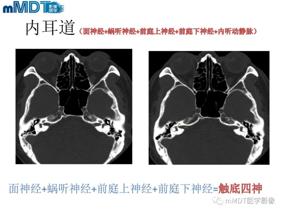 影像PPT - 【PPT】脑神经的影像辨识-48 影像PPT - 【PPT】脑神经的影像辨识-48