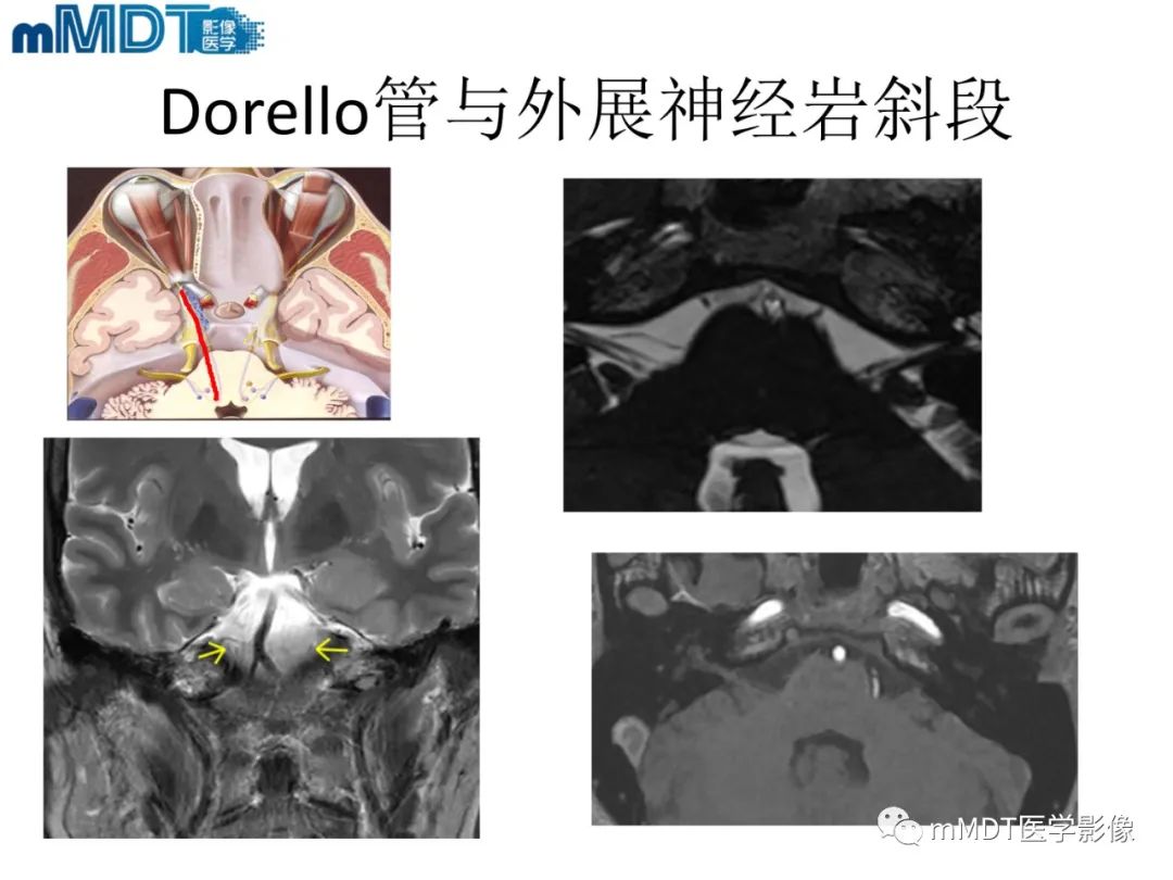 影像PPT - 【PPT】脑神经的影像辨识-47 影像PPT - 【PPT】脑神经的影像辨识-47