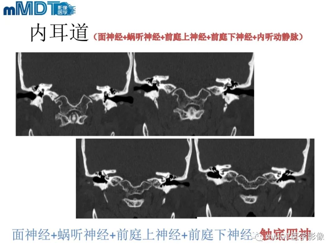 影像PPT - 【PPT】脑神经的影像辨识-49 影像PPT - 【PPT】脑神经的影像辨识-49