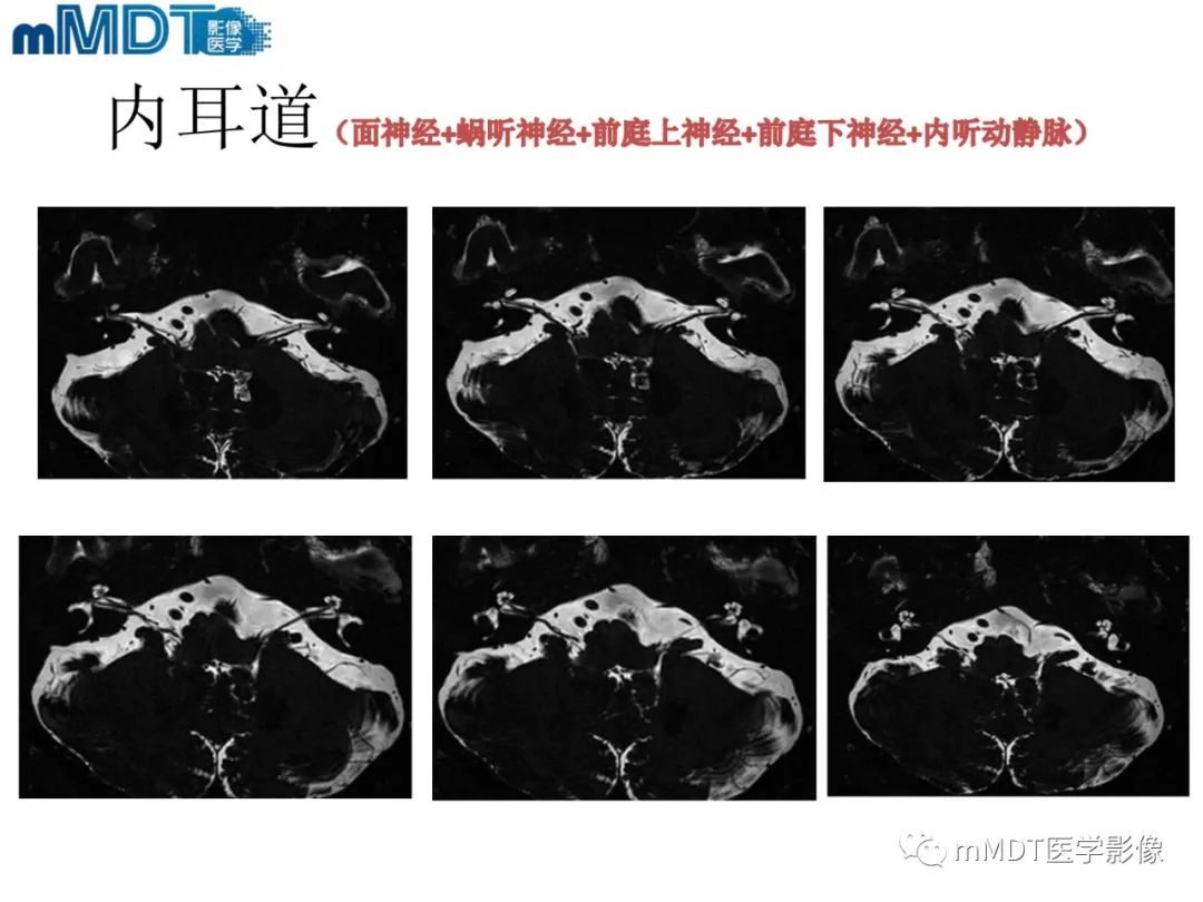 影像PPT - 【PPT】脑神经的影像辨识-51 影像PPT - 【PPT】脑神经的影像辨识-51