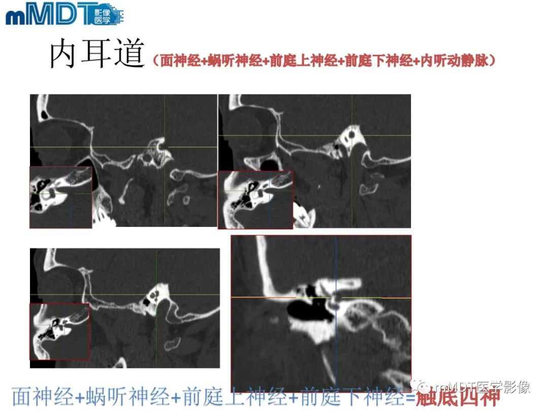 影像PPT - 【PPT】脑神经的影像辨识-50 影像PPT - 【PPT】脑神经的影像辨识-50