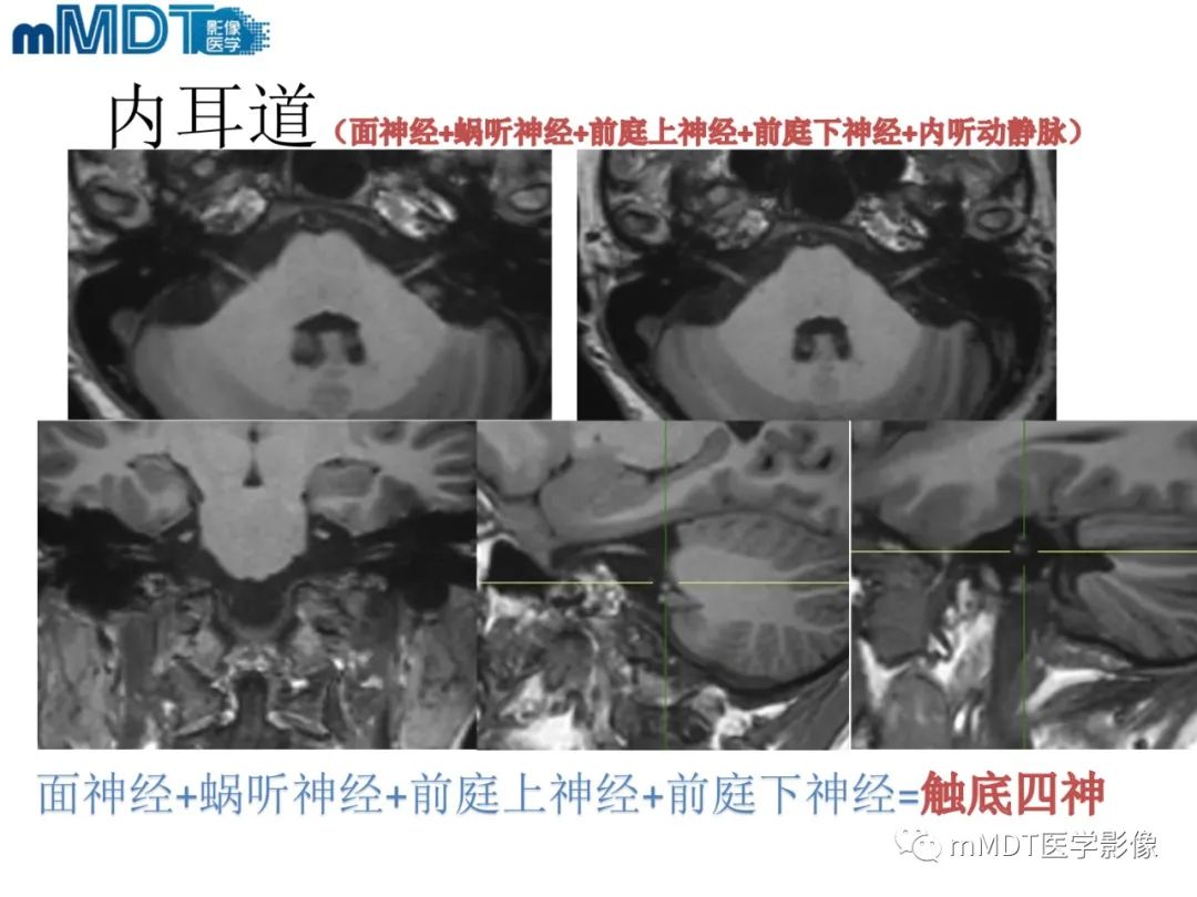 影像PPT - 【PPT】脑神经的影像辨识-52 影像PPT - 【PPT】脑神经的影像辨识-52