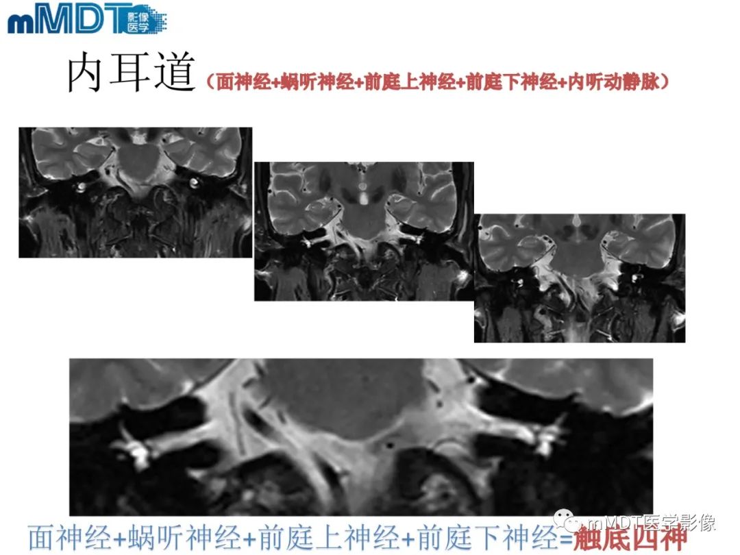 影像PPT - 【PPT】脑神经的影像辨识-53 影像PPT - 【PPT】脑神经的影像辨识-53