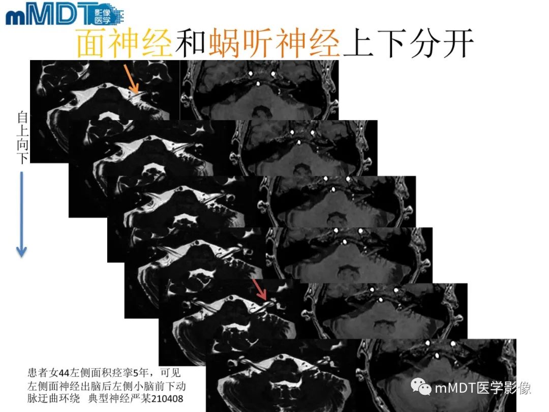 影像PPT - 【PPT】脑神经的影像辨识-54 影像PPT - 【PPT】脑神经的影像辨识-54