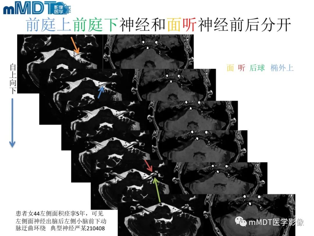 影像PPT - 【PPT】脑神经的影像辨识-56 影像PPT - 【PPT】脑神经的影像辨识-56