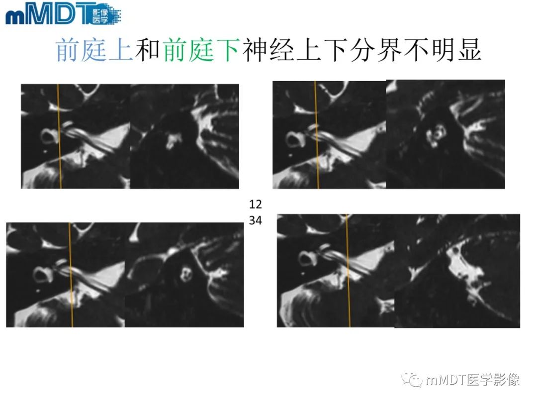 影像PPT - 【PPT】脑神经的影像辨识-58 影像PPT - 【PPT】脑神经的影像辨识-58