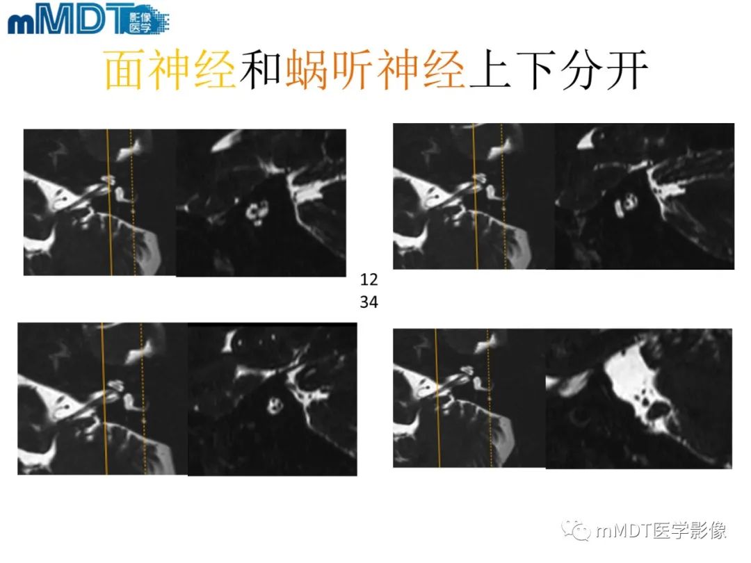 影像PPT - 【PPT】脑神经的影像辨识-55 影像PPT - 【PPT】脑神经的影像辨识-55