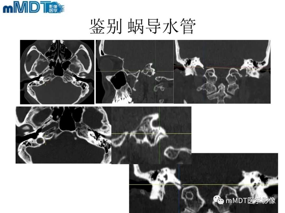 影像PPT - 【PPT】脑神经的影像辨识-59 影像PPT - 【PPT】脑神经的影像辨识-59