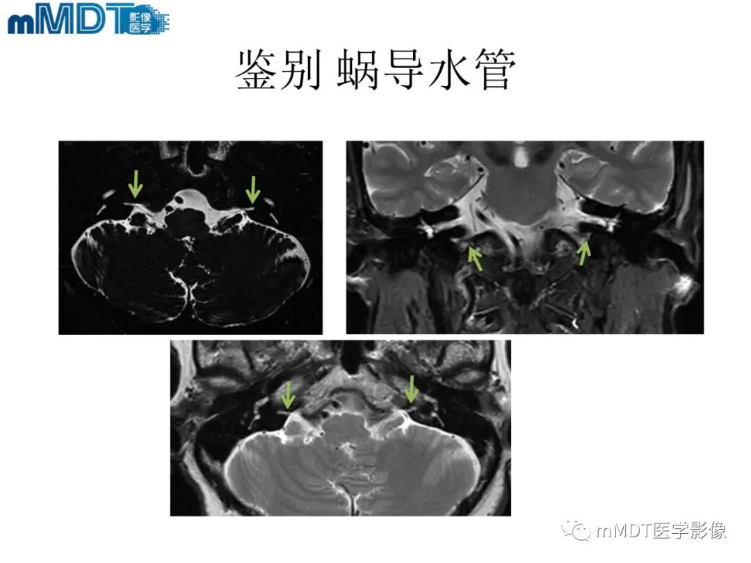 影像PPT - 【PPT】脑神经的影像辨识-61 影像PPT - 【PPT】脑神经的影像辨识-61