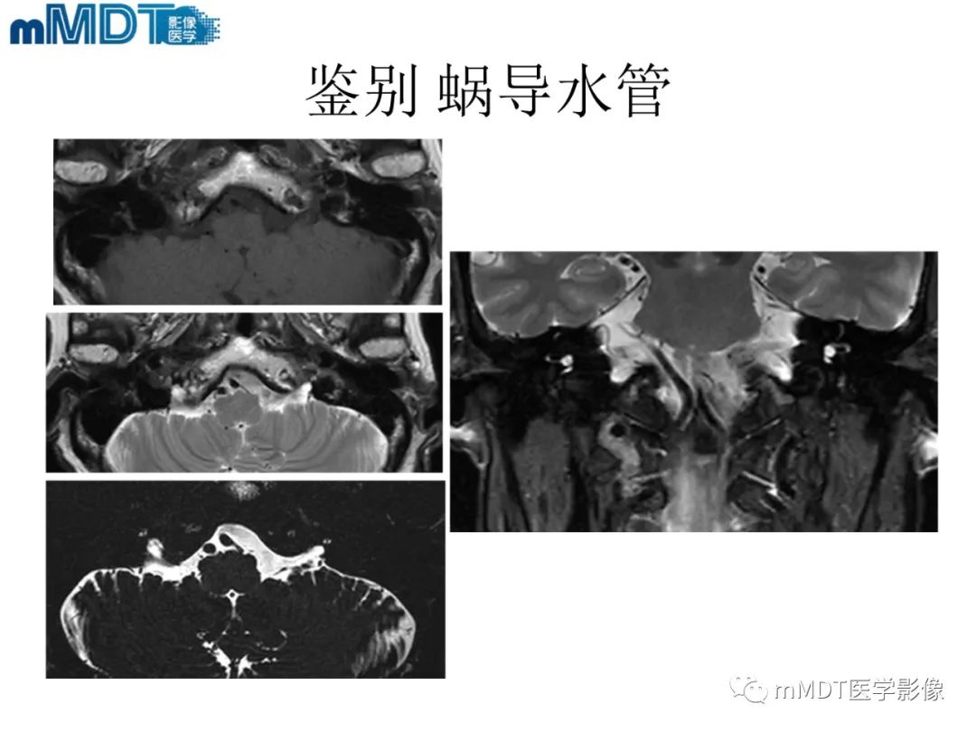 影像PPT - 【PPT】脑神经的影像辨识-62 影像PPT - 【PPT】脑神经的影像辨识-62