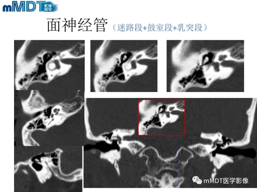 影像PPT - 【PPT】脑神经的影像辨识-63 影像PPT - 【PPT】脑神经的影像辨识-63