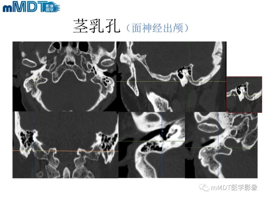 影像PPT - 【PPT】脑神经的影像辨识-64 影像PPT - 【PPT】脑神经的影像辨识-64