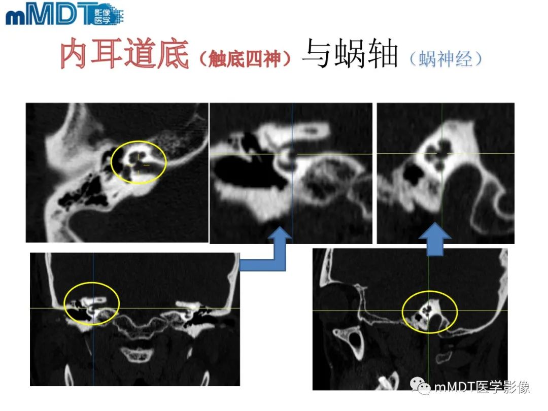 影像PPT - 【PPT】脑神经的影像辨识-65 影像PPT - 【PPT】脑神经的影像辨识-65